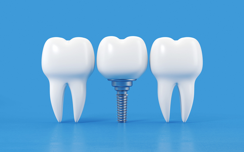 Dental implant education lifelong care guide at Fusion Implant Dentistry