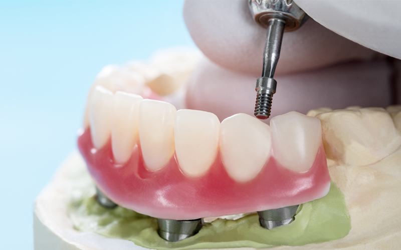 Implant supported dentures compared with modern tooth replacement solutions